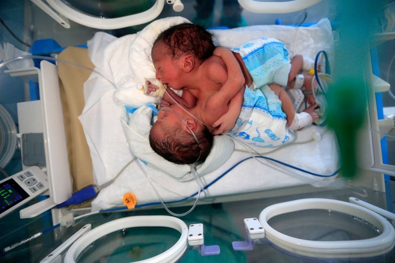 Des bébés siamois dans un état critique attendent une opération à l'étranger
