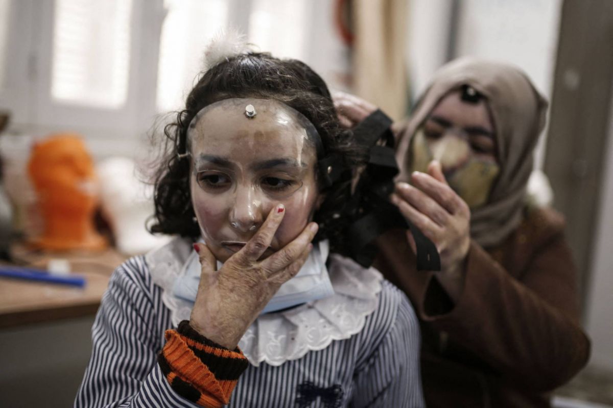 A Gaza, des masques thérapeutiques sur mesure pour les grands brûlés
