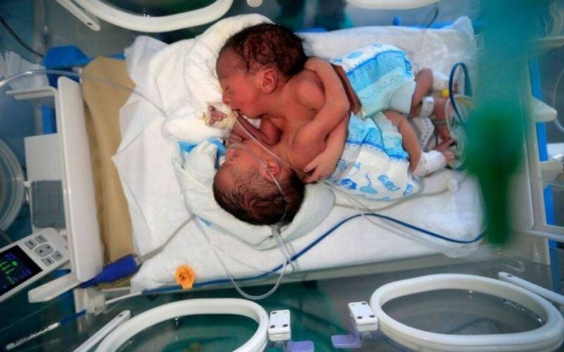 Décès d'un des jumeaux siamois yéménites séparés par des médecins saoudiens