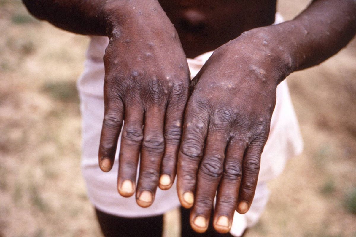 Variole du singe : les cas pourraient s'accélérer en Europe, avertit l'OMS