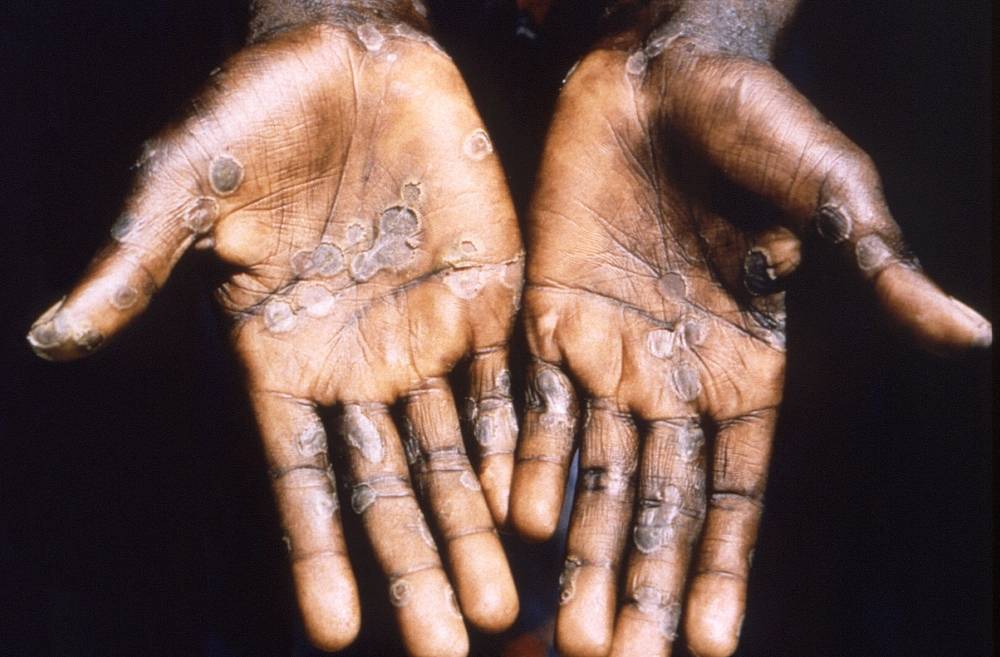 Variole du singe : premiers cas en République Tchèque, Autriche et Slovénie