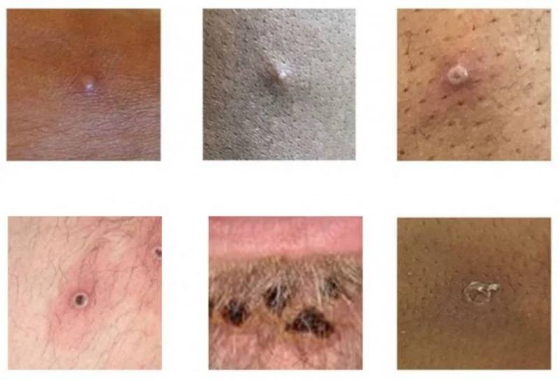 Variole du singe : plus de 5.000 cas confirmés, selon l'OMS