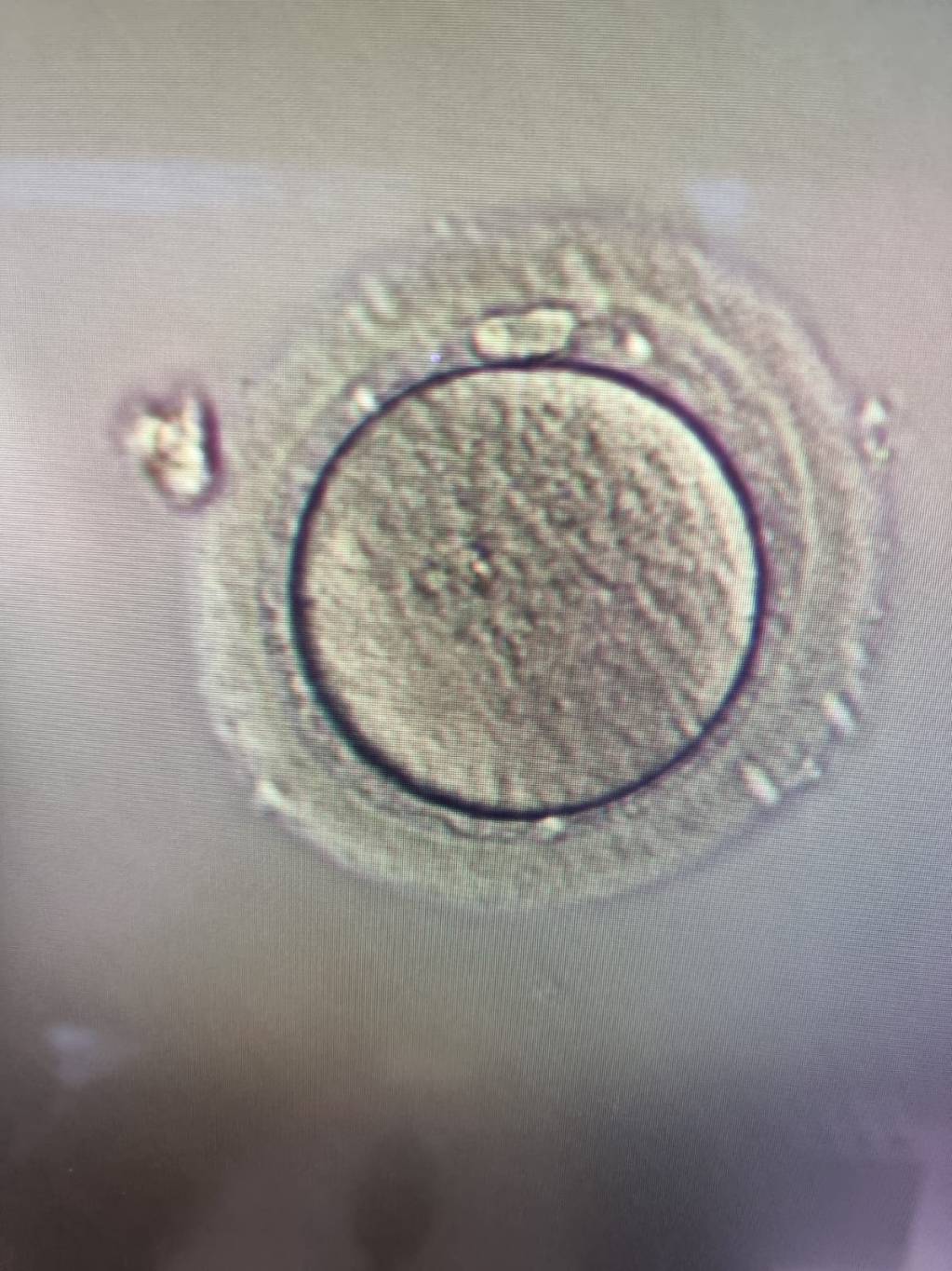 Congélation d’ovocytes comment s’y prendre au Liban L