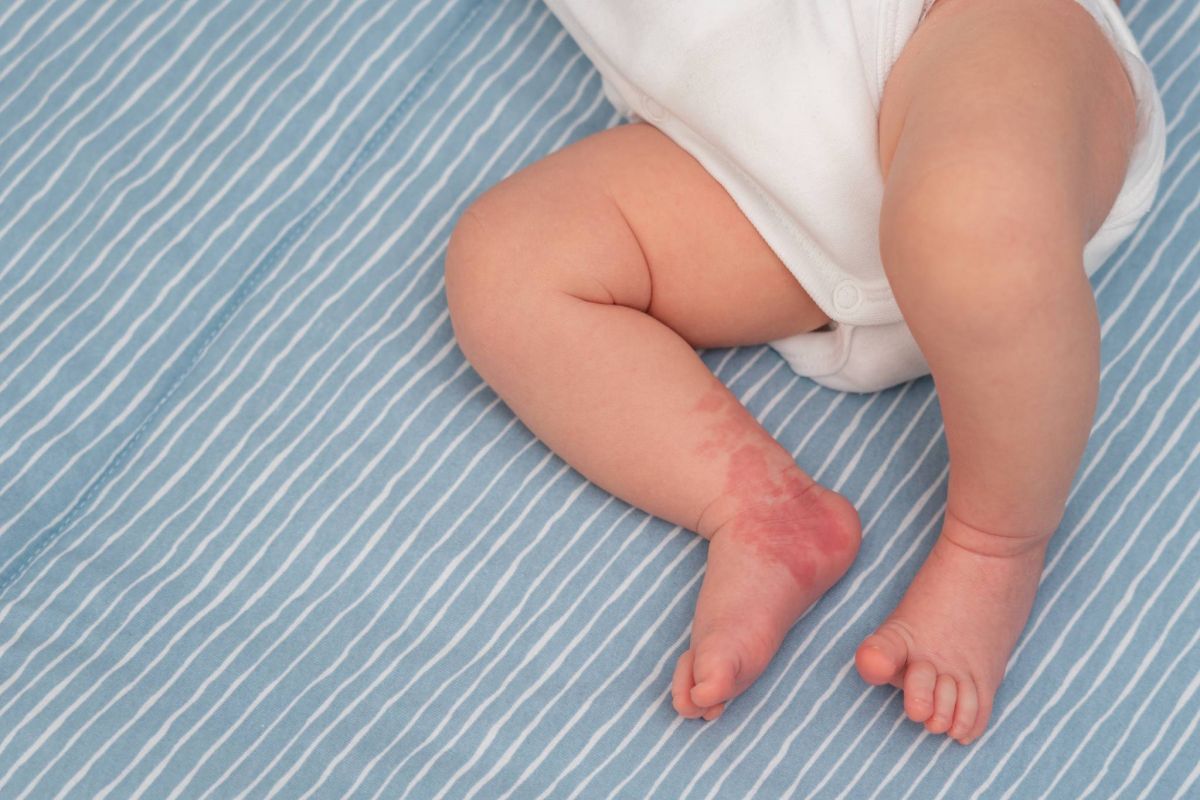 Les hémangiomes de nos petits anges