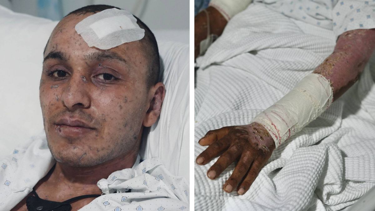 Lebanon's only specialized major burns center for war victims faces critical funding shortage