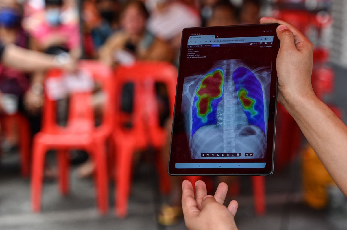 Feu vert à un premier test de diagnostic de la tuberculose