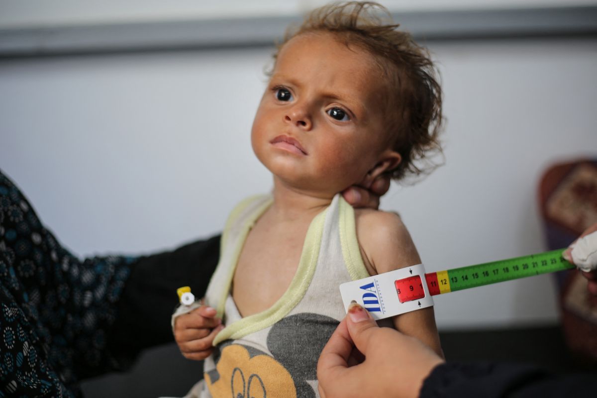 MSF says quarter of young children malnourished